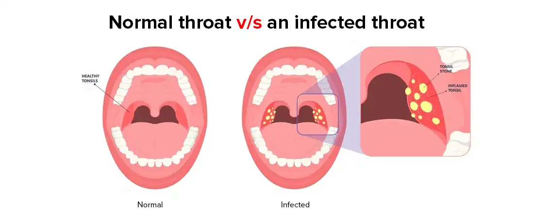 Normal Throat VS Infected Throat